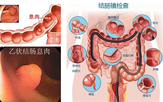 萎縮性胃炎真的“很?chē)樔恕?？看完這“七個(gè)事實(shí)”你就明白了