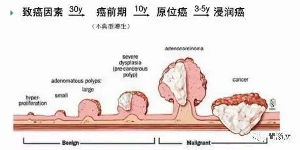 體檢查出腸息肉一定要切除！ 95%腸癌由它演變而來(lái)