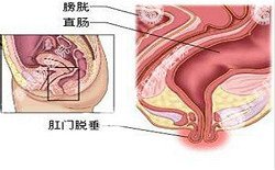南寧治療脫肛哪家醫院好？南寧脫肛治療多少錢(qián)？